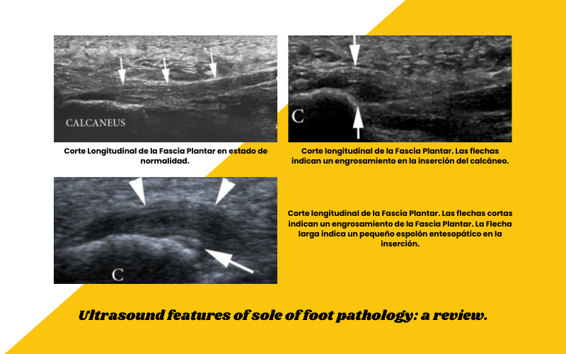 5. Preguntas y respuestas ecografia fascitis plantar delgado plantar osgood schlatter.png